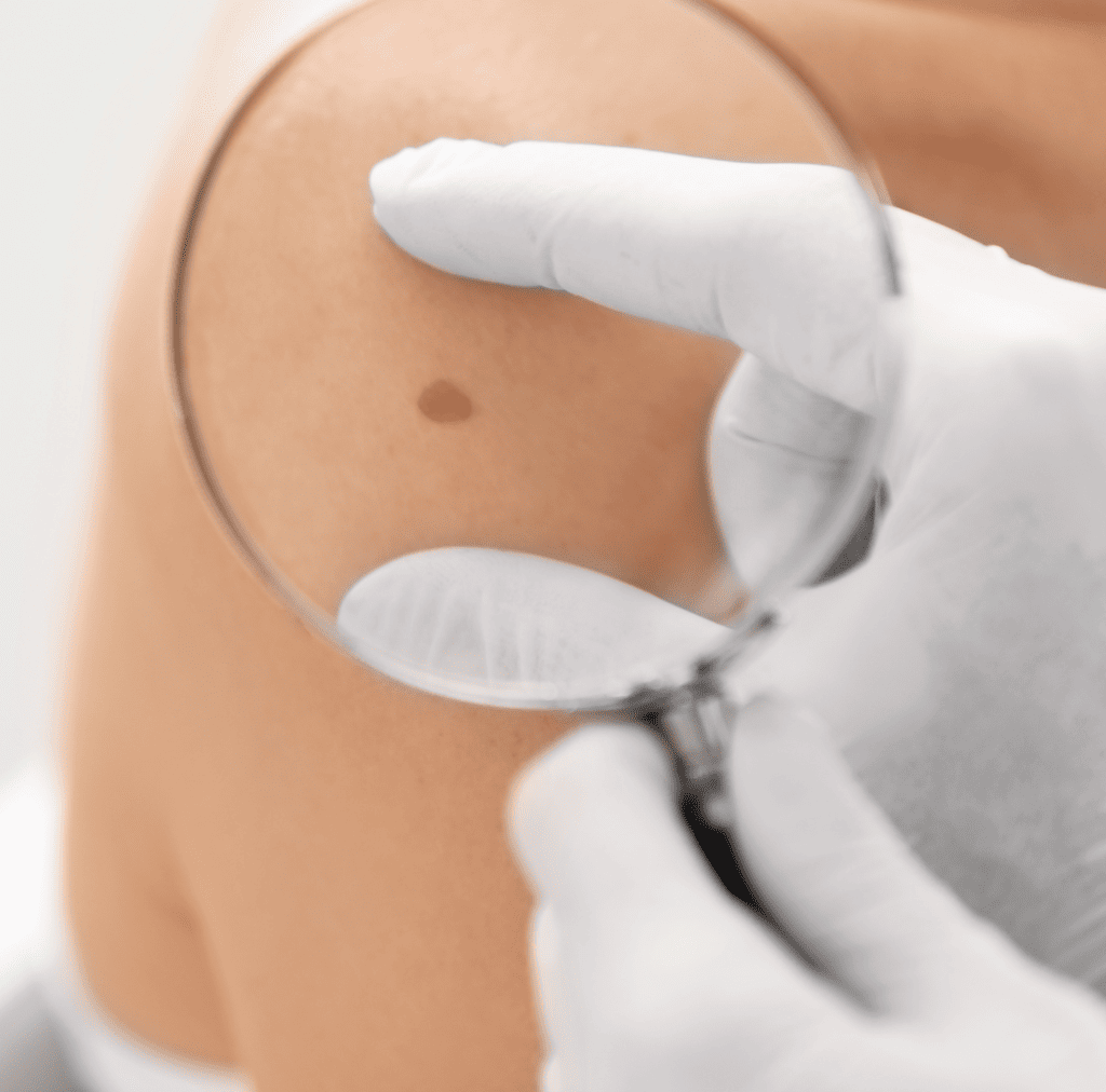skin cancer blog