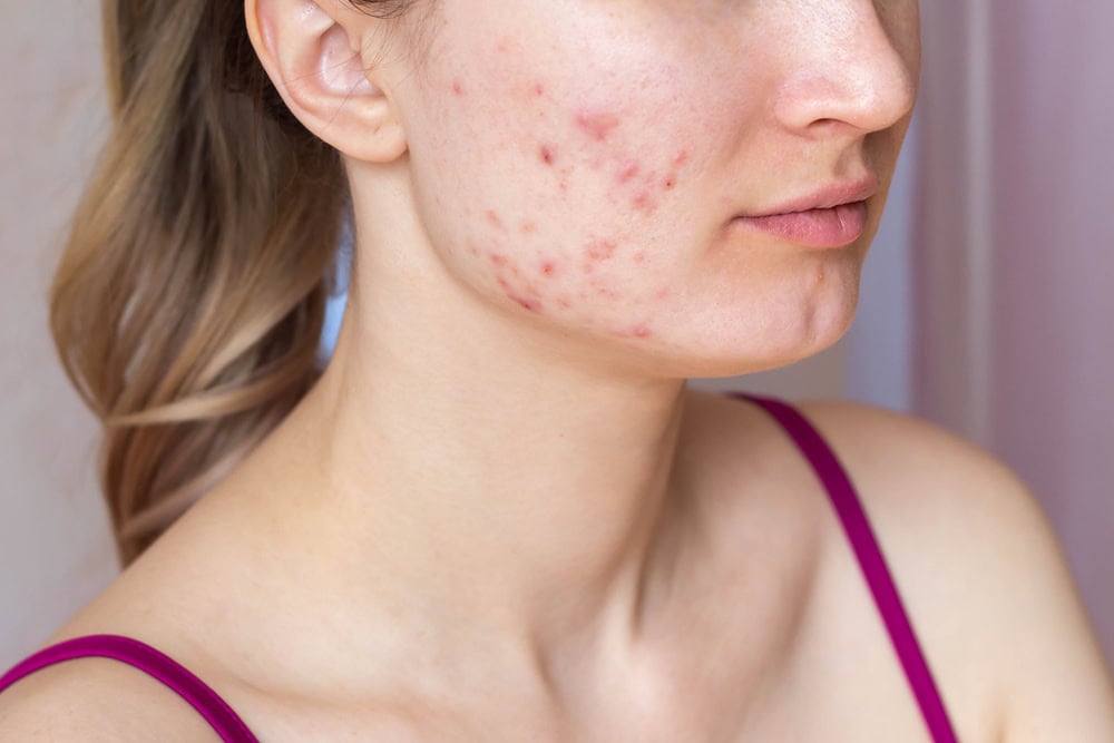 Cropped,Shot,Of,A,Young,Woman's,Face,With,The,Problem